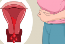Lạc nội mạc tử cung và 6 dấu hiệu điển hình của căn bệnh này mà con gái không nên chủ quan bỏ qua - Kiến Thức Chia Sẻ 1
