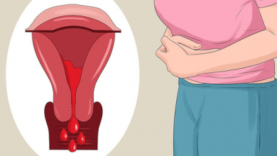 Lạc nội mạc tử cung và 6 dấu hiệu điển hình của căn bệnh này mà con gái không nên chủ quan bỏ qua - Kiến Thức Chia Sẻ 15