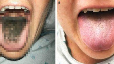 "Lông mọc trong lưỡi" - căn bệnh cực hiếm chứng minh rằng chuyện quái gì cũng có thể xảy ra - Kiến Thức Chia Sẻ 4