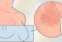 Ngứa dữ dội ở vùng ngực có thể ngầm cảnh báo 5 vấn đề sức khỏe sau đây - Kiến Thức Chia Sẻ 12