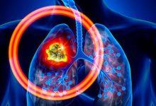Ngăn ngừa ung thư phổi từ sớm nhờ duy trì 5 thói quen sau đây mỗi ngày - Kiến Thức Chia Sẻ 12