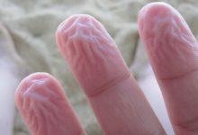 Da tay bị nhăn nheo cũng có thể cảnh báo một loạt vấn đề sức khỏe tiềm ẩn - Kiến Thức Chia Sẻ 12