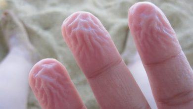 Da tay bị nhăn nheo cũng có thể cảnh báo một loạt vấn đề sức khỏe tiềm ẩn - Kiến Thức Chia Sẻ 5