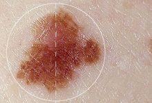 Cận thận với 5 biểu hiện nốt ruồi báo hiệu ung thư - Kiến Thức Chia Sẻ 28