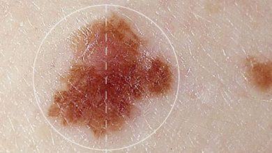 Cận thận với 5 biểu hiện nốt ruồi báo hiệu ung thư - Kiến Thức Chia Sẻ 6