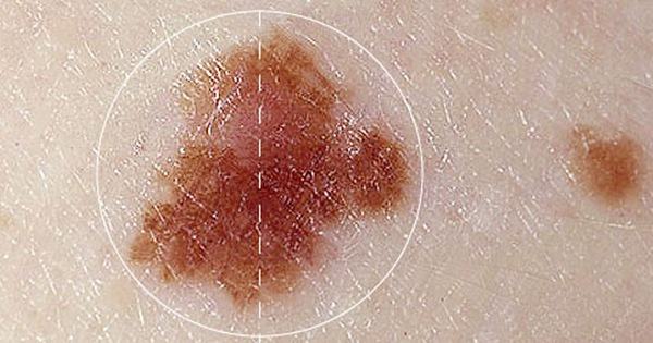 Cận thận với 5 biểu hiện nốt ruồi báo hiệu ung thư - Kiến Thức Chia Sẻ 1