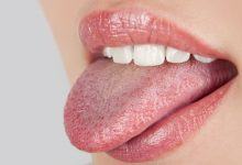 Những dấu hiệu khác lạ ở vùng lưỡi cảnh báo một số vấn đề sức khỏe mà bạn không hề hay biết - Kiến Thức Chia Sẻ 10