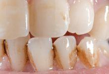 5 nguyên nhân tiềm ẩn gây ố vàng răng mà nhiều người không ngờ đến - Kiến Thức Chia Sẻ 18