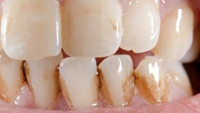 5 nguyên nhân tiềm ẩn gây ố vàng răng mà nhiều người không ngờ đến - Kiến Thức Chia Sẻ 6