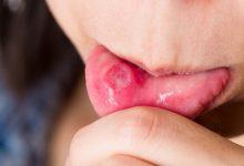 Da bị viêm đỏ, bụng căng phồng, lưỡi trắng toát... đều là những dấu hiệu sức khỏe mà bạn không nên xem thường - Kiến Thức Chia Sẻ 5