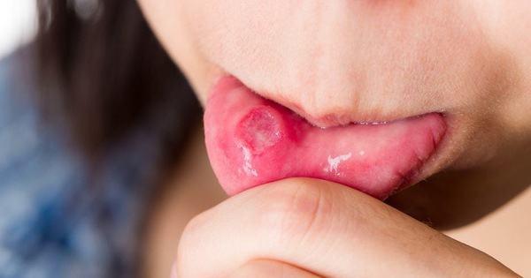 Da bị viêm đỏ, bụng căng phồng, lưỡi trắng toát... đều là những dấu hiệu sức khỏe mà bạn không nên xem thường - Kiến Thức Chia Sẻ 28