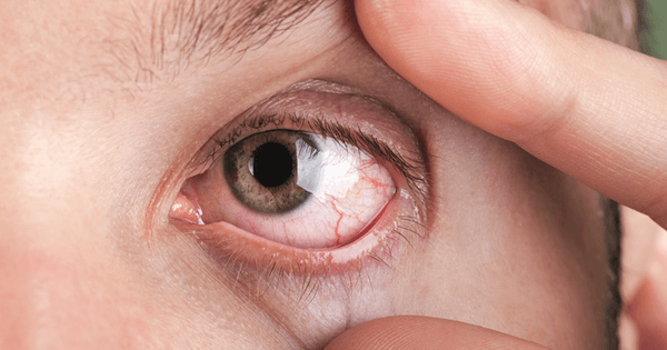 Đau mắt đỏ có thể là do 4 nguyên nhân sức khỏe mà bạn không ngờ đến - Kiến Thức Chia Sẻ 19