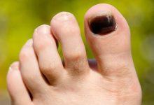 Thấy móng chân xuất hiện những vệt tím đen là những dấu hiệu cảnh báo sức khỏe mà bạn không nên xem thường - Kiến Thức Chia Sẻ 46