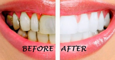 Top 12 Cách làm đẹp răng tự nhiên, trắng sáng hiệu quả nhất