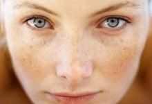 Bật mí bí quyết giúp ngừa tăng sắc tố da vào mùa hè 11